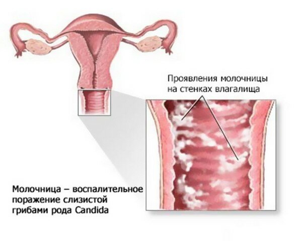 молочница у женщин